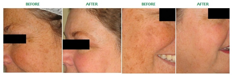 Microdermabrasion