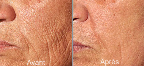 Microneedling