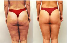 Cellulite Reduction