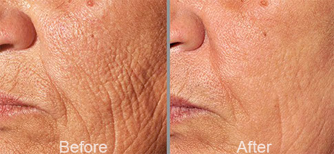 Microneedling